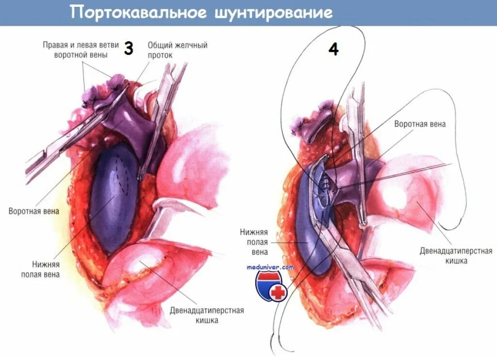 Чреспеченочное портокавальное шунтирование. Портокавальное шунтирование при портальной гипертензии. Шунтирование печёночной вены. Операции портосистемное шунтирование.