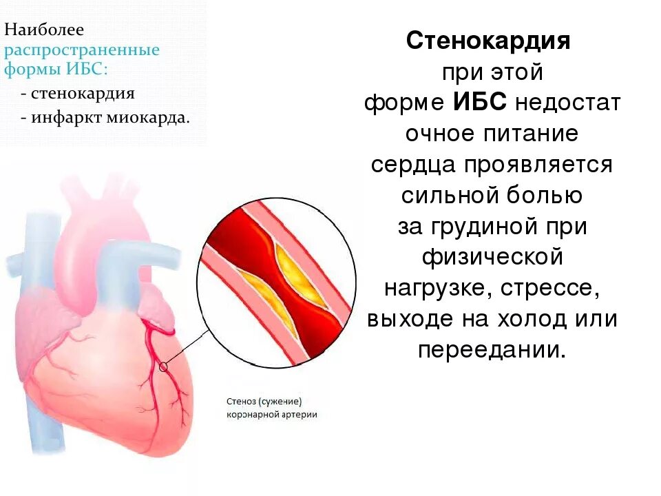 Ибс сердца что это симптомы. Ишемическая болезнь сердца симптомы профилактика. ибс стенокардия инфаркт миокарда. клинические проявления ишемической болезни сердца. стенокардия при ишемической болезни.