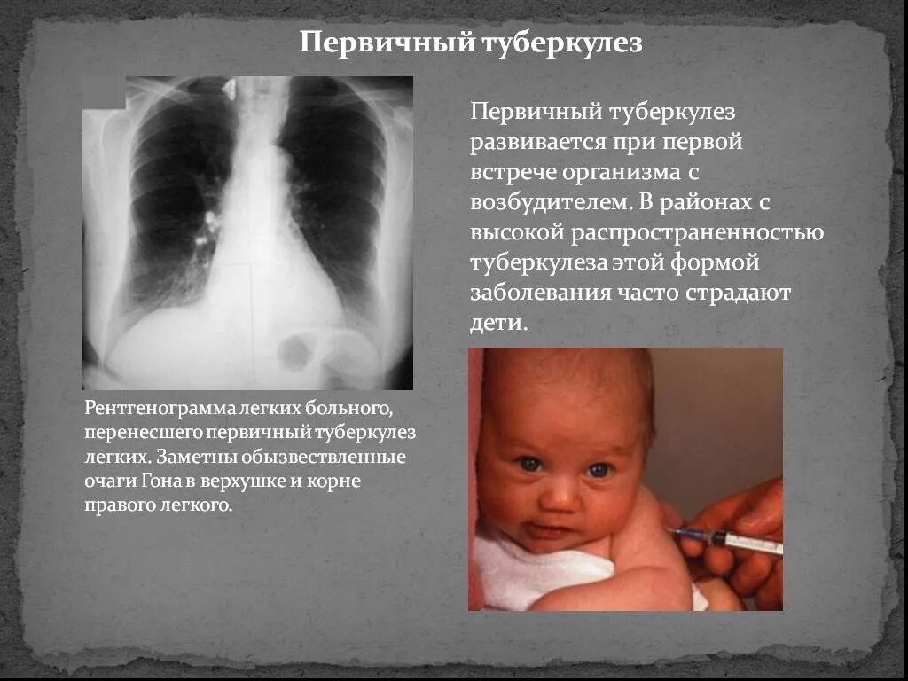 Специфическая профилактика туберкулеза. Туберкулез у детей презентация. Профилактика туберкулеза презентация. Туберкулез у детей презентация. Профилактика заболевания туберкулезом у детей.