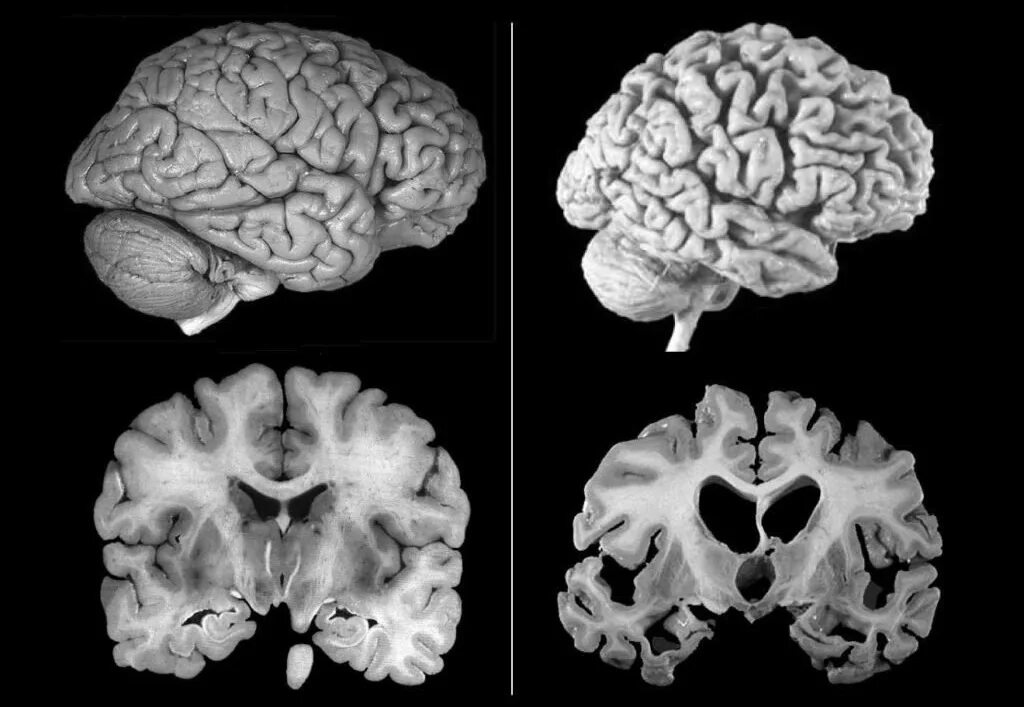 Brain disease. Болезнь Альцгеймера. Мозг при болезни Альцгеймера. Атрофические болезни мозга.