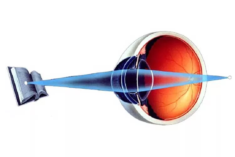 Почему у людей пожилого возраста развивается дальнозоркость. Пресбиопия (возрастная дальнозоркость). Пресбиопия офтальмоскопия. Пресбиопия глаз. Пресбиопия это в офтальмологии.