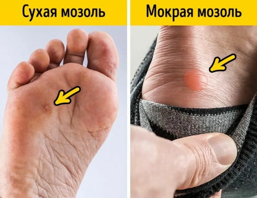 Как выглядит пятка на ноге
