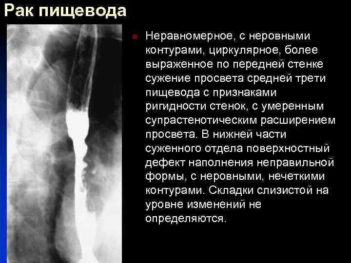 Стеноз пищевода рентген степени. Супрастенотическое расширение пищевода. Циркулярное сужение пищевода. Циркулярная стриктура пищевода.