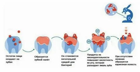 Аристон кариес