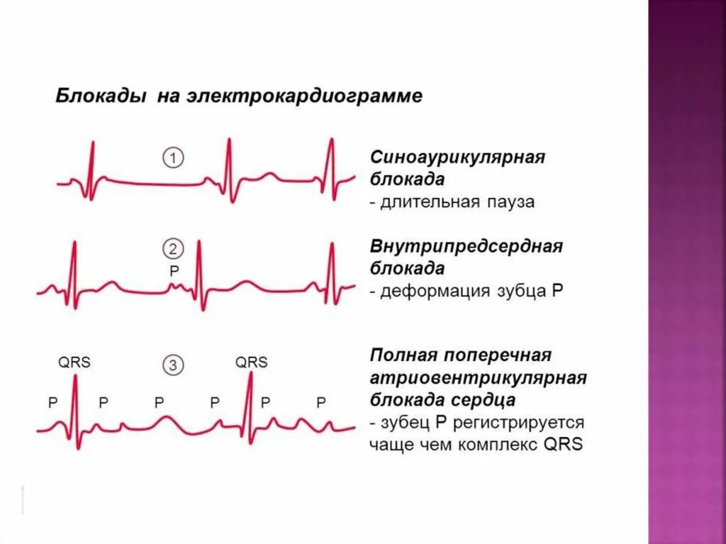 Синоаурикулярная блокада. Внутрипредсердная блокада на ЭКГ. Синоаурикулярная блокада на ЭКГ. ЭКГ при синоаурикулярной блокаде. Полная поперечная блокада на ЭКГ.