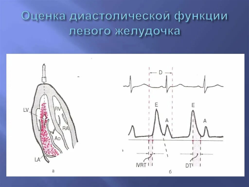 Дисфункции желудочков сердца. Диастолическая дисфункция левого желудочка на ЭКГ. Оценка диастолической функции левого желудочка. IVRT диастолическая дисфункция ЭХОКГ. Систолическая функция левого желудочка 73.