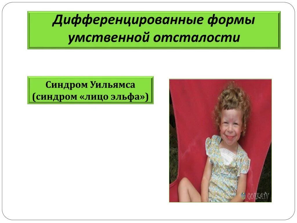 Синдром умственной отсталости. Дифференцированные формы умственной отсталости. дифференцированные формы олигофрении. умственная отсталости синдром эльфа. дифференциальные формы уо.