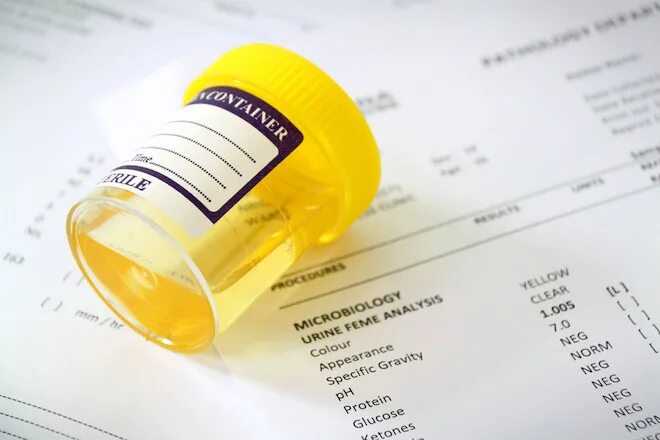 Как должна выглядеть нормальная моча Gross, Microscopic & Chemical examination of urine Renal physiology, Kidney dise