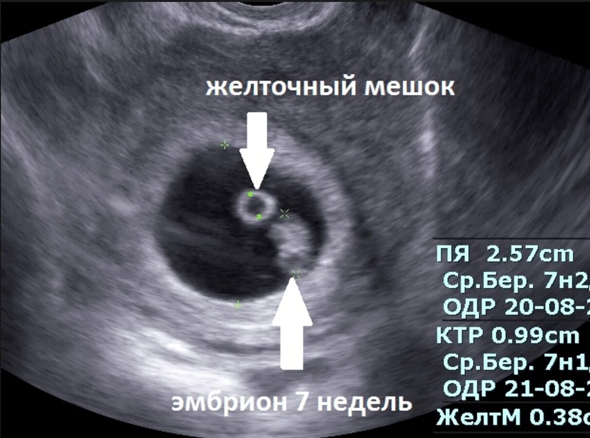 УЗИ 6 недель беременности желточный мешок. Плодное яйцо с эмбрионом и желточным мешком. УЗИ плодного яйца на 5 неделе беременности. Плодное яйцо на 6 неделе беременности УЗИ. 8 недели задержки