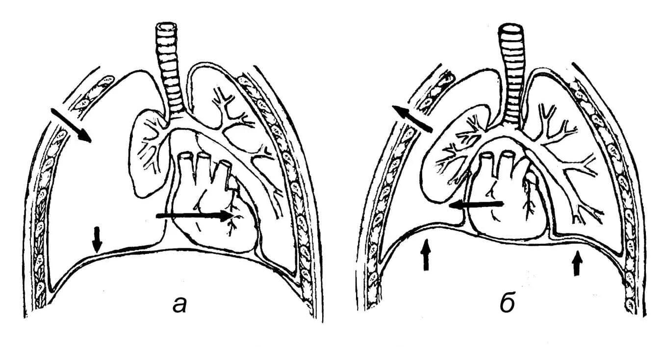 Систему дыхания при эмфиземе и пневмотораксе.. Открытый и клапанный пневмоторакс. Клапанный пневмоторакс. Клапанный пневмоторакс схема. Наличие крови в плевральной полости