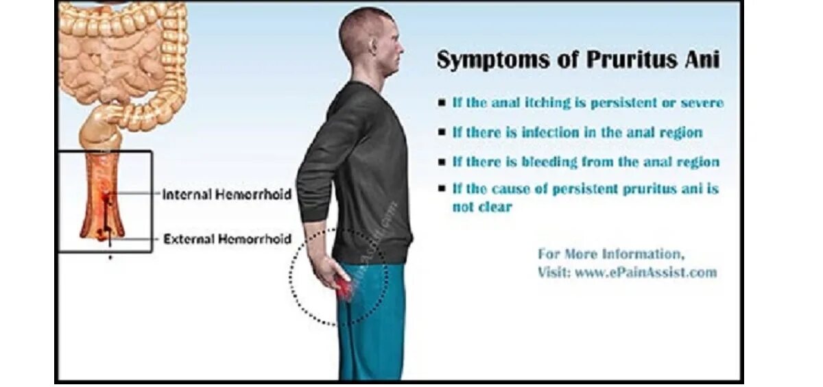 Ощущение в прямой кишке. Зуд и дискомфорт в заднем проходе. Зуд и резь в заднем проходе. Зуд в заднем проходе у мужчин. Острая боль в заднем проходе.