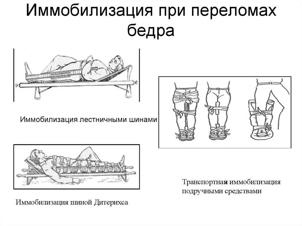 Иммобилизация при переломе бедренной кости шины. Иммобилизация при чрезвертельном переломе бедра. Транспортная иммобилизация при переломе бедренной кости. Протяженность транспортной иммобилизации перелома бедра. Этапы лечения переломов