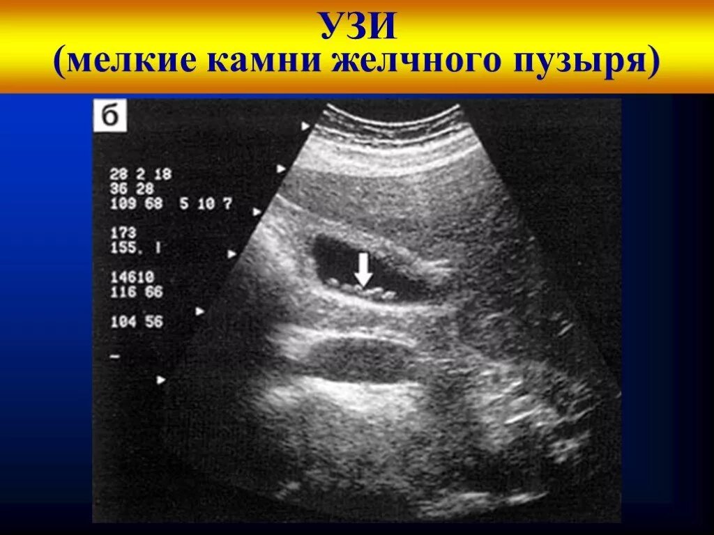 Конкременты желчного пузыря УЗИ. Камни в желчном пузыре УЗИ. Конкременты желчного пузыря при ультразвук. Холестериновые камни в желчном на УЗИ. Узи сократимости желчного пузыря