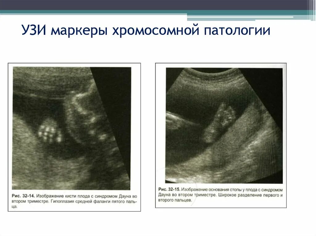 Гипоплазия 12 недель