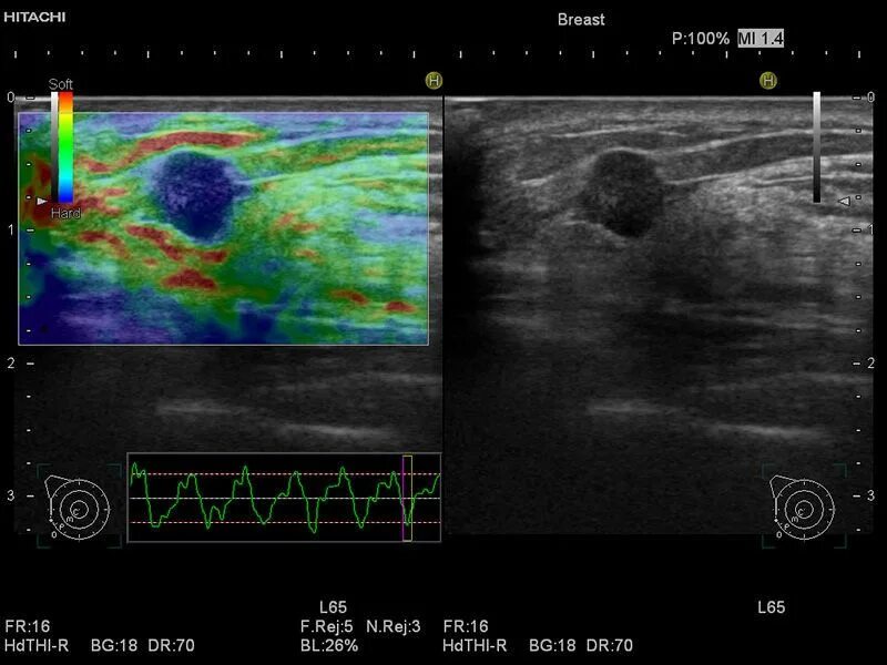 Эластография щитовидной железы что это. Компрессионная эластография предстательной железы. Эластография молочных желез шкала. Эластография молочной железы протокол. Эластография сдвиговой волны.