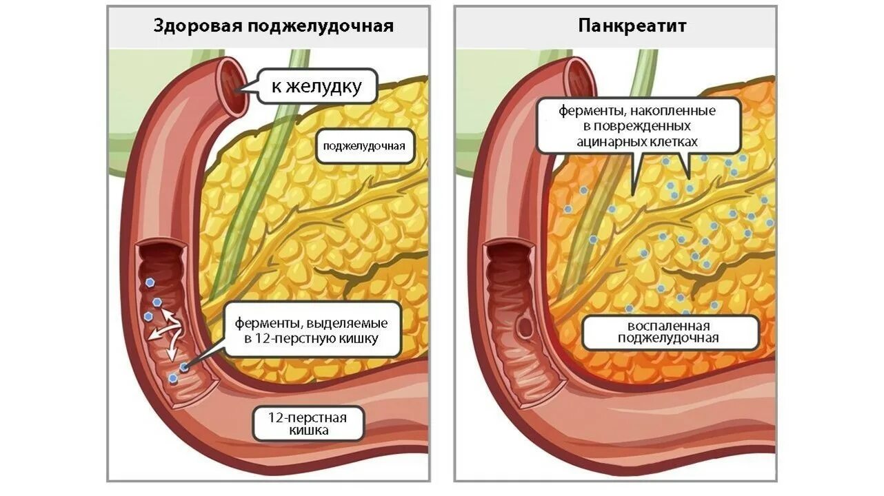 Где у человека находится поджелудочная железа показать. Здоровая поджелудочная. Поджелудочная железа человека. Здоровая поджелудочная железа.