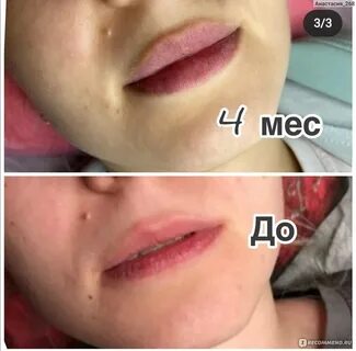 Дермалакс для увеличения губ