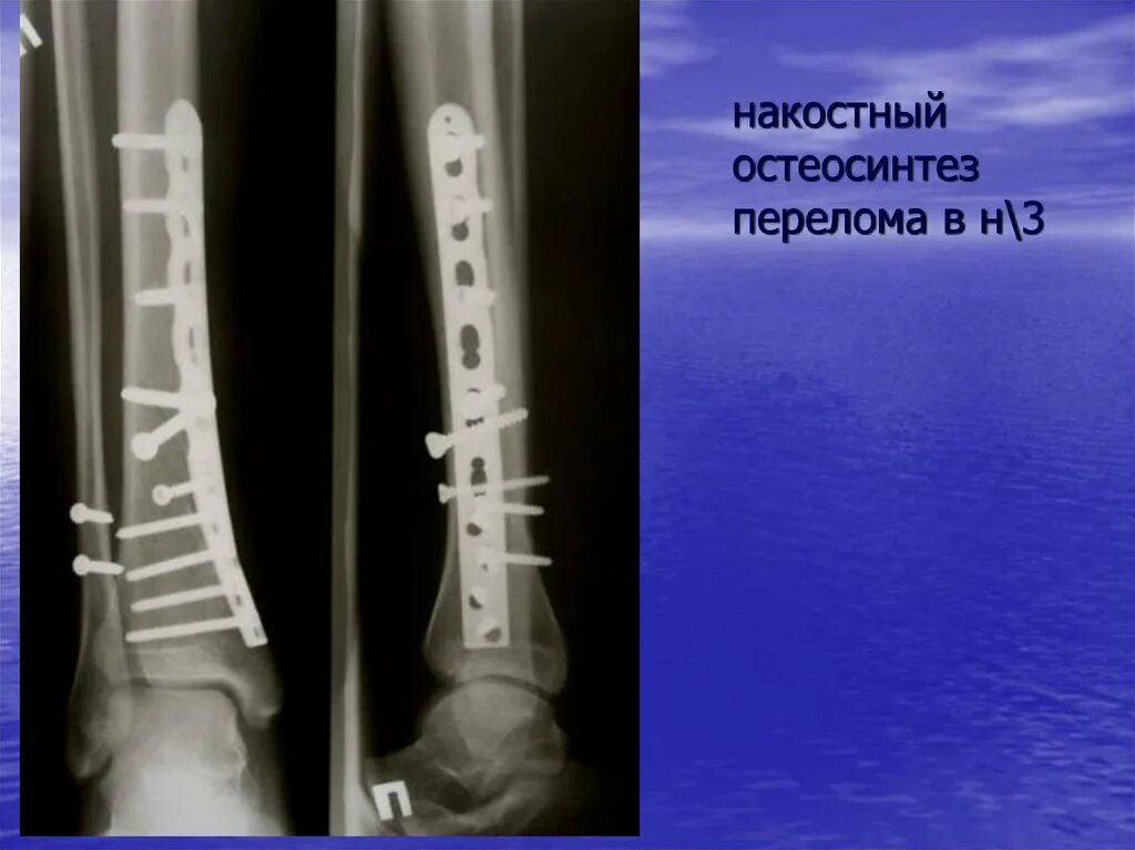 Перелом голени остеосинтез