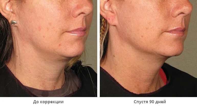 Спейслифтинг Цены на лифтинг Мендельсона в Москве