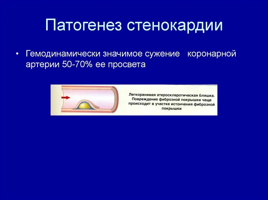 Гемодинамически значимый стеноз артерий. Патогенез стенокардии. гемодинамически значимые стенозы коронарных артерий. гемодинамически значимый стеноз коронарных артерий. гемодинамически значимым считается стеноз коронарной артерии.