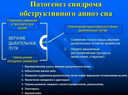Обструктивное апноэ сна