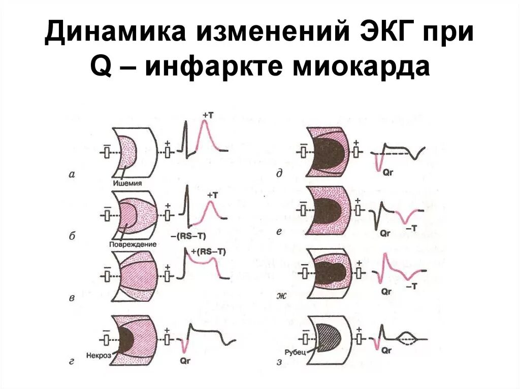 Изменение зубца q. ЭКГ при острейшей стадии инфаркта миокарда. ЭКГ при различных стадиях инфаркта миокарда. Периоды инфаркта миокарда на ЭКГ. Фазы острой стадии инфаркта миокарда.