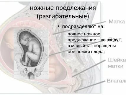 Беременность 31 недель тазовое предлежание