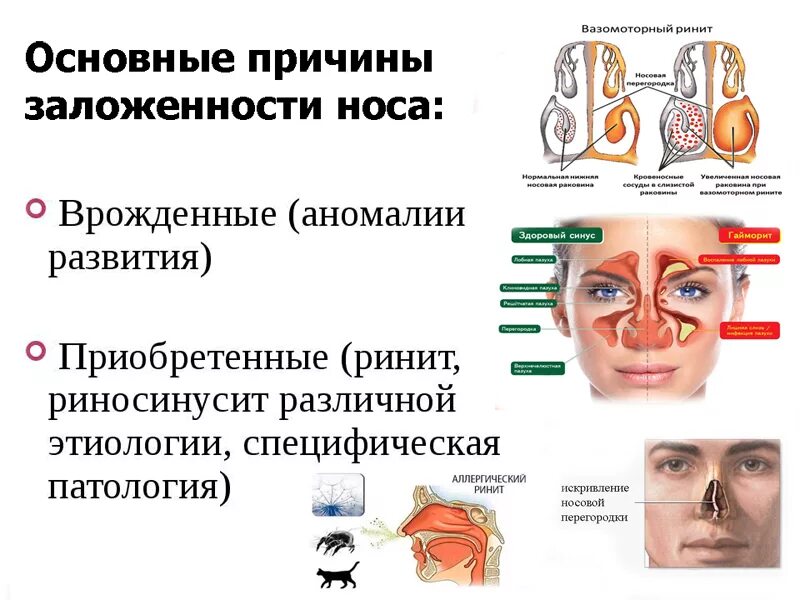 Заложенность носа насморка причины и лечение. Почепочему закладывает нос. Причины заложенности носа.