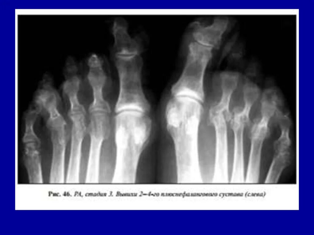 Артрит рентгенологические стадии. Ревматоидный артрит рентгенограмма. Ревматоидный артрит 3 стадия рентген. Ревматоидный артрит 4 стадия рентген. Ревматоидный артрит кистей рук рентген.