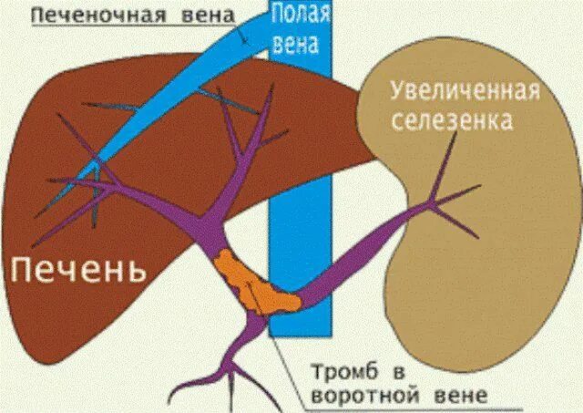 Тромбоз печеночных вен синдром Бадда-Киари. Портальная гипертензия селезеночная Вена. Синдром воротная Вена. Портальная гипертензия синдром Бадда-Киари. Какая вена в печени