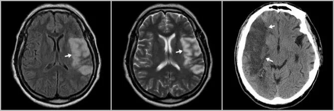 Доли мозга мрт. Инсульт височной доли. Инсульт височной доли мозга. Инсульт височной доли на кт. Инсульт левой височной доли мозга последствия.
