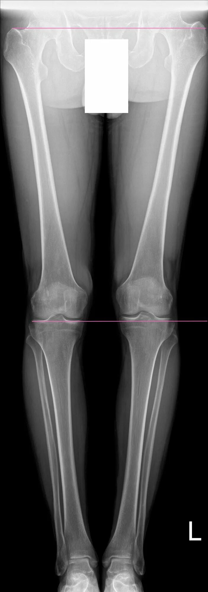 Slot рентген нижних конечностей. Гарринча рентген ноги.