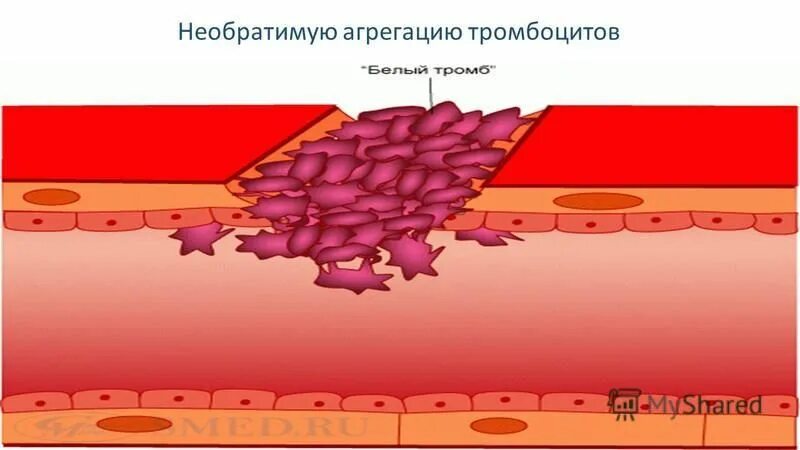 При повреждении сосудов тромбоциты. Необратимая агрегация тромбоцитов. Тромбоцитнери агрегация. Место разрушения тромбоцитов. Агрегация анатомия тромбоцитов.