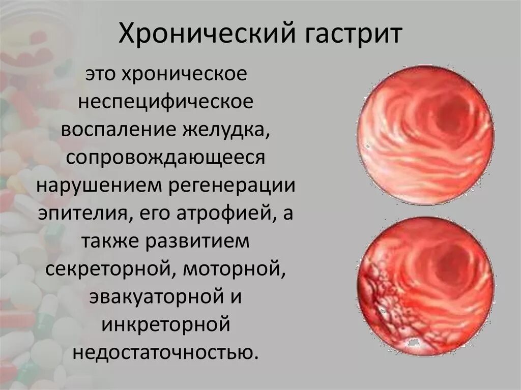 Признаки атрофией слизистой оболочки. Хронический эритематозно геморрагический гастрит. Хронический гастрит с секреторной недостаточностью. Эоаничесуий гастрит это.