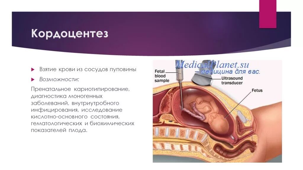 Инвазивные методы пренатальной диагностики плода кордоцентез. Биопсия хориона амниоцентез кордоцентез. Трансабдоминальный кордоцентез. Кордоцентез сущность метода.