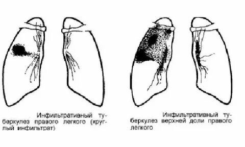 Признаки инфильтративных изменений в легких что