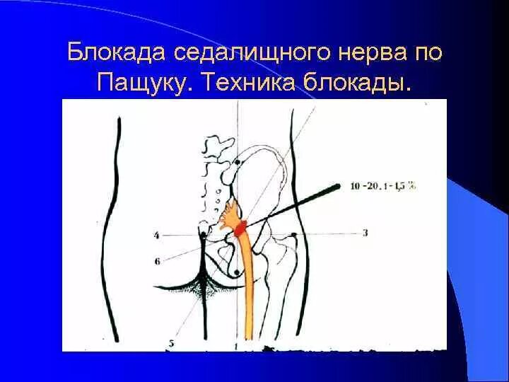 Блокада при защемлении седалищного. Блокада седалищного нерва техника. Блокада седалищного нерва анестезия. Блокада грушевидной мышцы техника. Воспаление седалищного нерва блокада.