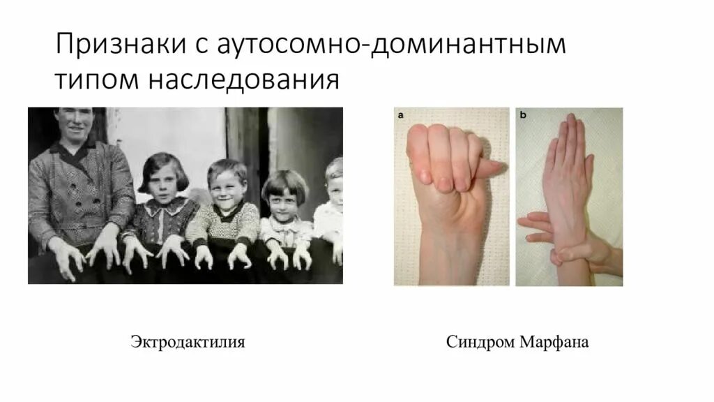 Аутосомно рецессивная родословная. Синдром марфана тип наследования. Синдром марфана наследуется как аутосомно доминантный признак. Синдром марфана тип наследования генетика. Наследственные болезни синдром марфана.