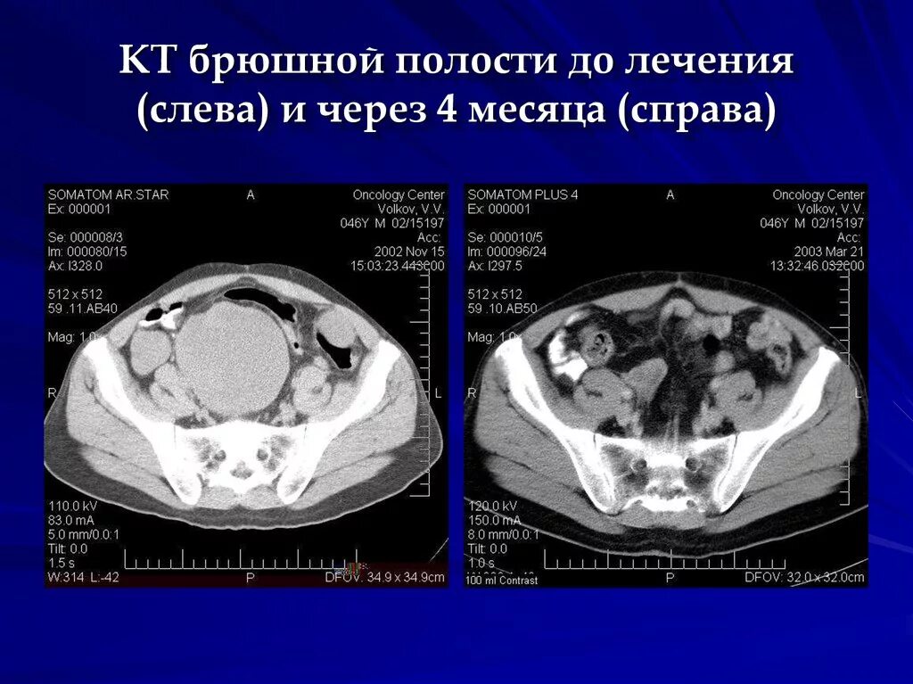 Что такое абдоминальная онкология. Опухоли брюшной полости на кт. Новообразования в органах брюшной полости.. Объемное образование брюшной полости кт. Неоплазия брюшной полости.