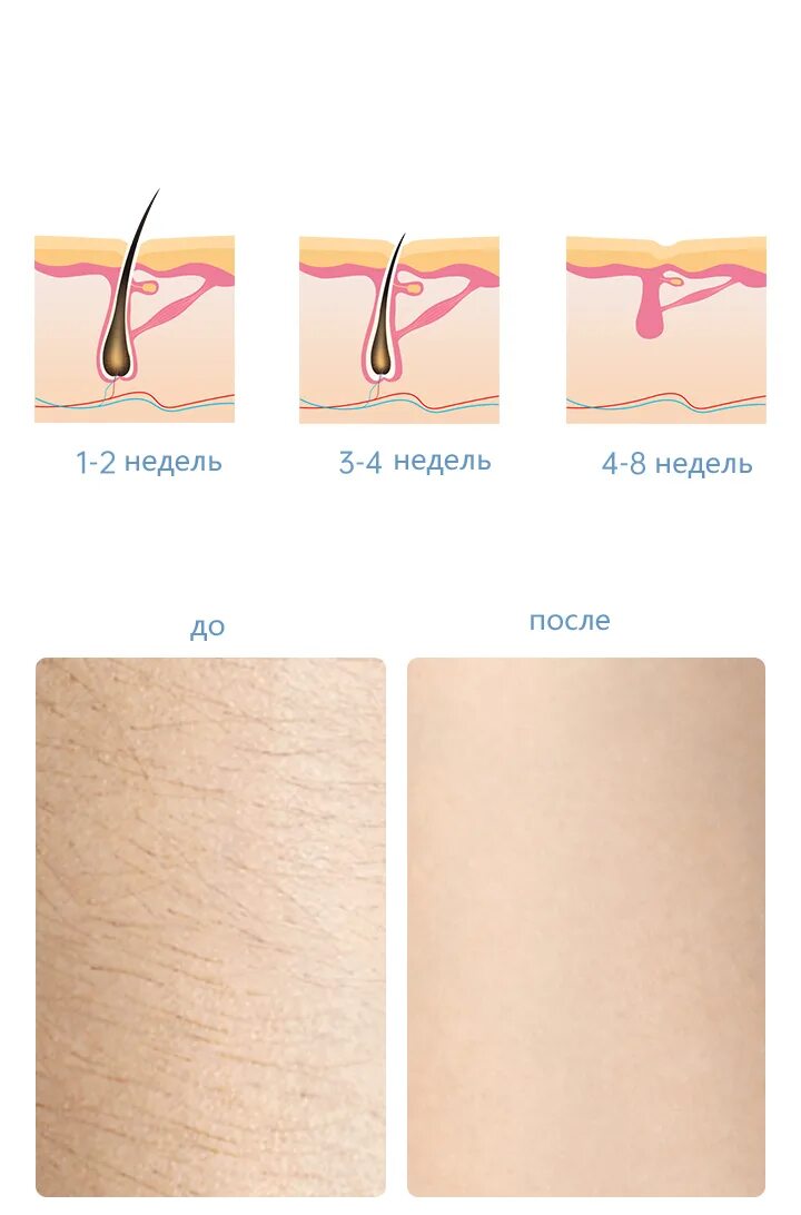 Девушка с эпилятором. Кристальный эпилятор. Лазерный эпилятор xiaomi inface. Эпилятор для ног. Как эпилятор удаляет волосы.