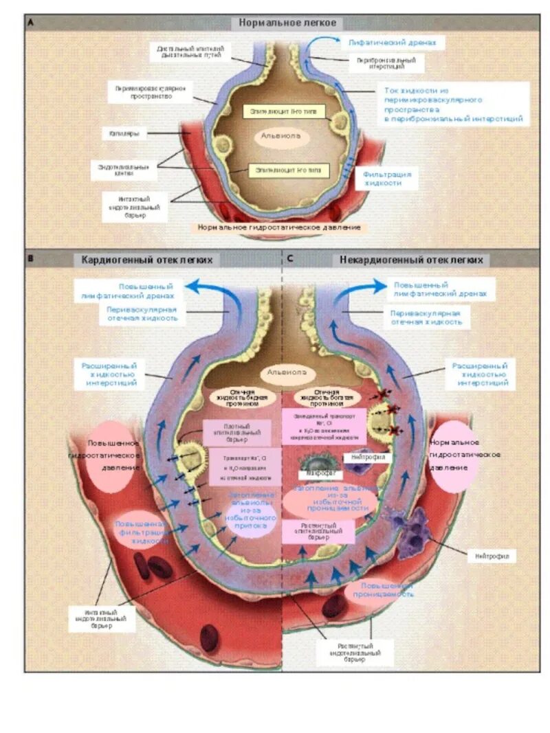 Кардиогенный отек легких патогенез. Патогенез кардиогенного отёка лёгких. Отек легких патогенез патофизиология. Кардиогенный отек легкого патогенез. Отек легких механизм