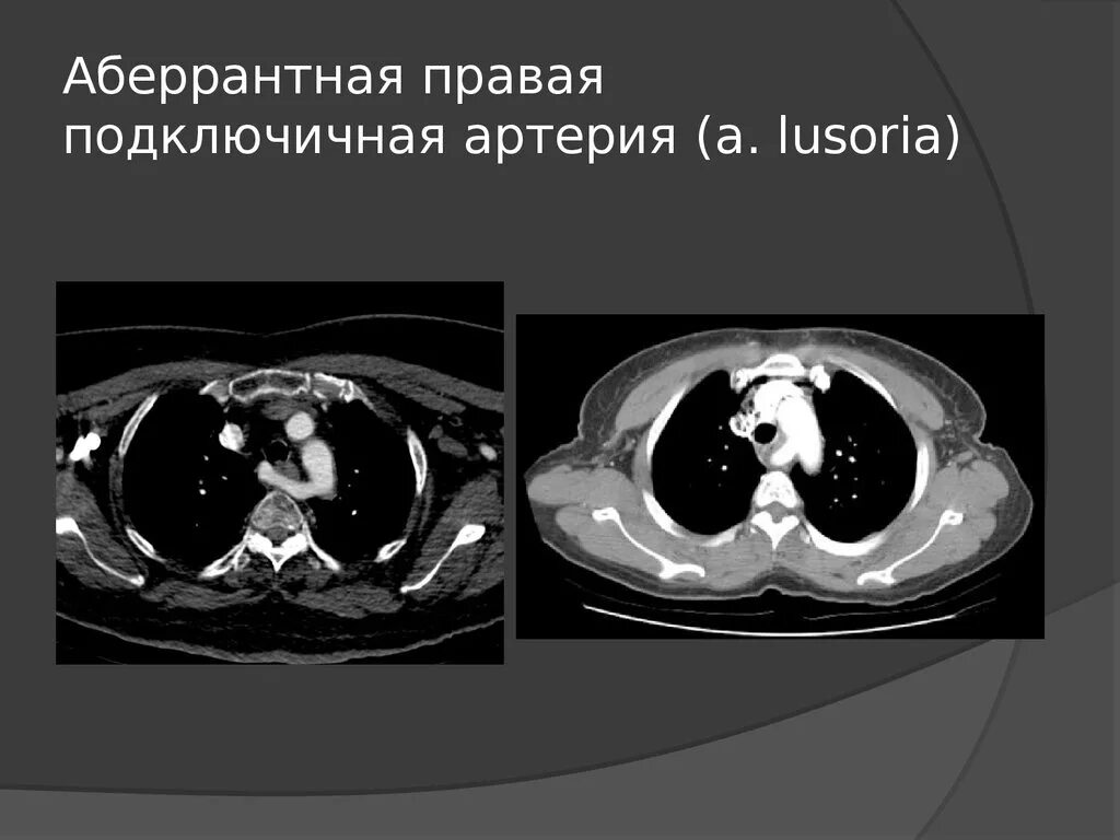 Аберрантная правая подключичная артерия. Аберрантная правая подключичная артерия кт. Аббкрантная правая подключичная артерия. Правая аберрантная подключичная артерия у плода.