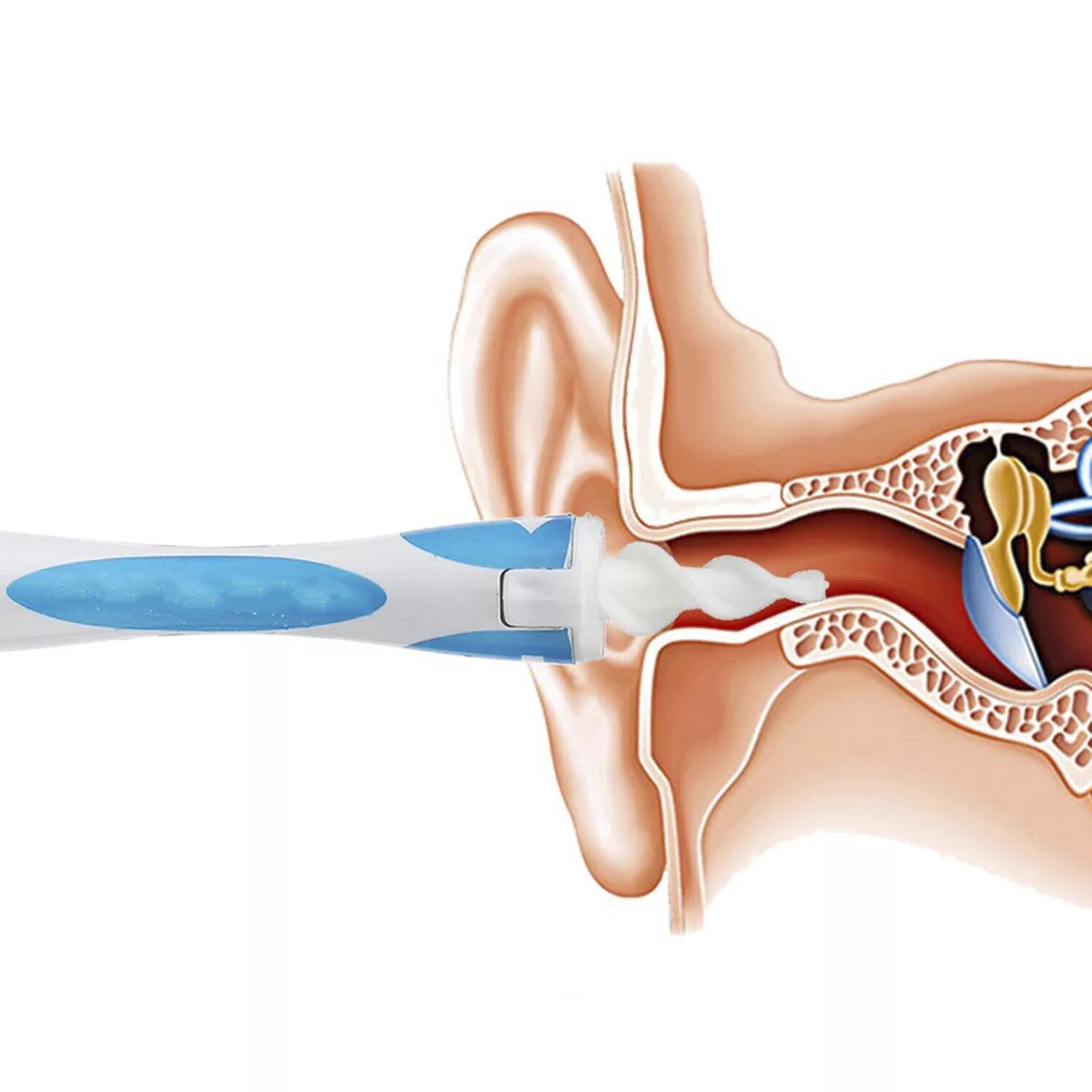 Clean ear. Прибор для чистки ушей от серных пробок. Аппарат для очистки ушей от серных пробок. Вакуумная чистка ушей.