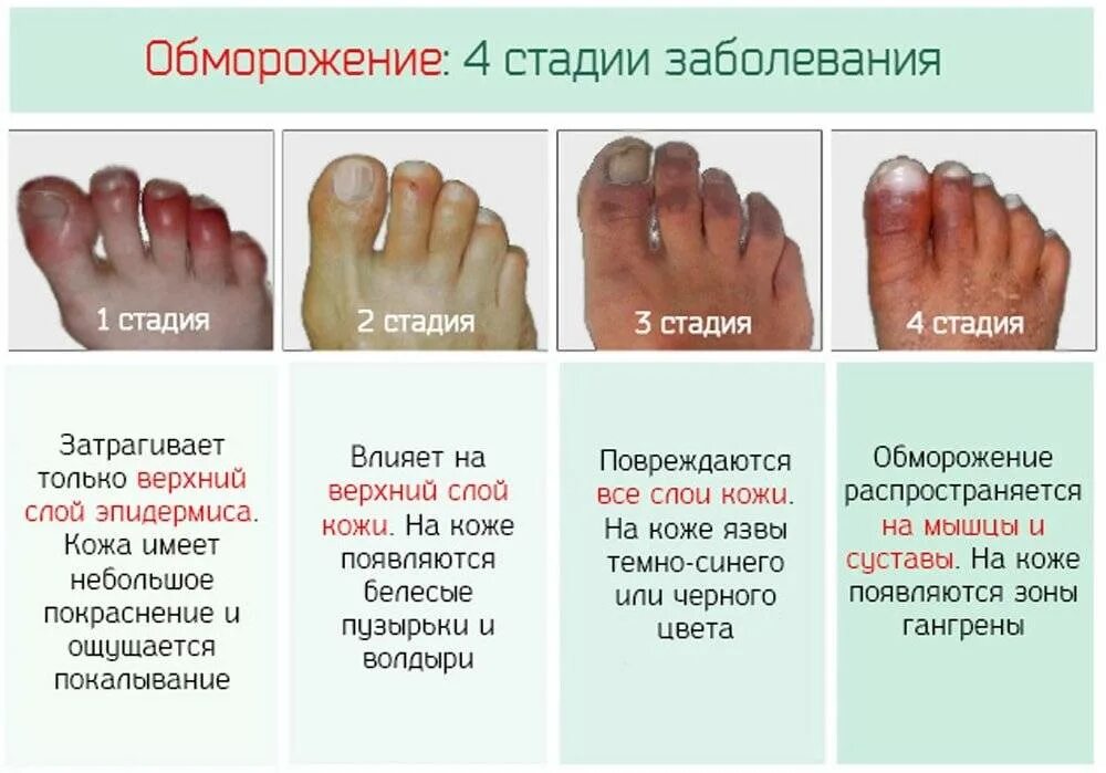 Как понять что у тебя обморожение пальцев. Обморожение 2 степени таблица. симптом 2 и 3 степени обморожения. признаки отморожения iv степени:. симптомы 2 степени отморожения.