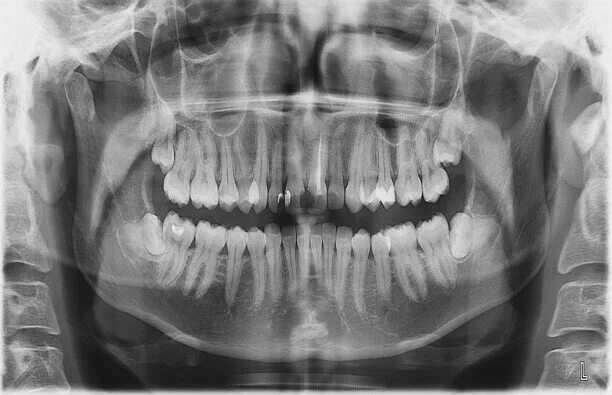 рентген сестрорецк. рентген аппарат digieye 560. пневмоторакс справа рентген. анатомия ключицы рентген. рентген аппарат clascan-800.