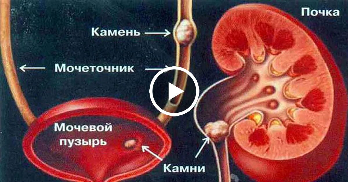 Мочекаменная болезнь колики. Мочекаменная болезнь мочеточника. Мочеполовая система камни в почках. Мочекаменная болезнь почечная колика. Камни в мочеточнике и мочевом пузыре.