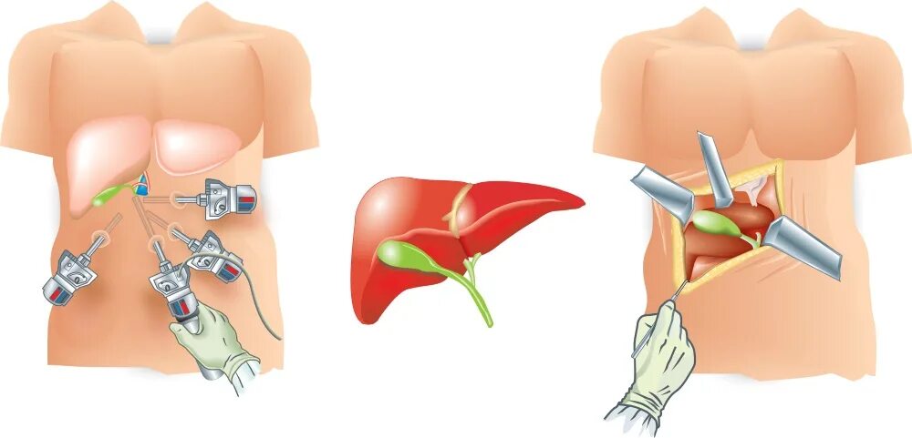 Операция по удалению печени. Холецистит и лапароскопическая холецистэктомия. ЖКБ лапароскопическая холецистэктомия. Желчекаменная болезнь лапароскопия. ЖКБ операция лапароскопия.