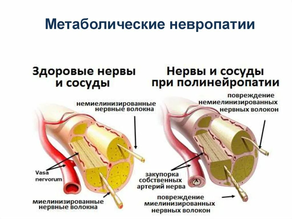 Метаболическая полинейропатия нижних конечностей. Дифтерийная полиневропатия. Дифтерийные полинейропатии. Осложнения полиневропатии.