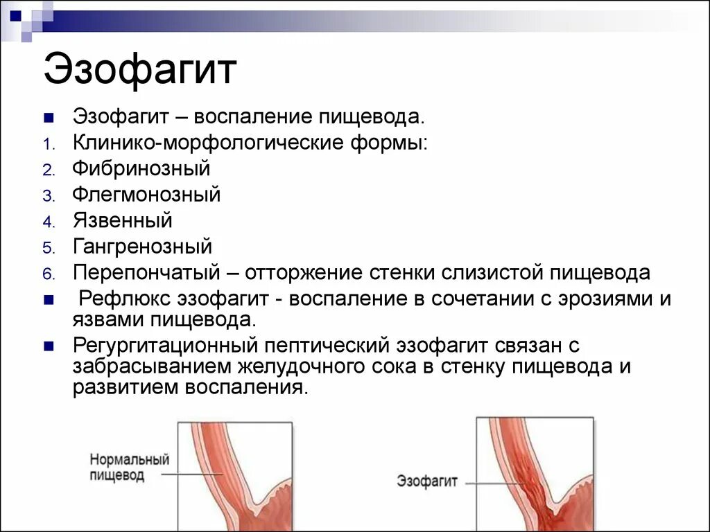 Дистальный отдел слизистой пищевода. Эзофагит медикаментозное лечение