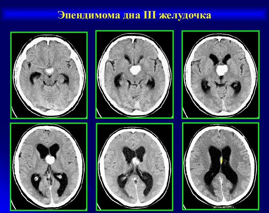 Образования желудочков мозга. 3 Желудочек на кт. Эпендимома 4 желудочка мрт. Опухоль 3 желудочка головного мозга кт. 3 Желудочек мозга на кт.